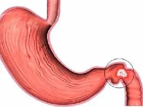 12 exacerbarea tratamentul ulcerului și ulcer duodenal la domiciliu