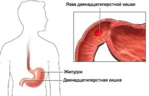 12 exacerbarea tratamentul ulcerului și ulcer duodenal la domiciliu