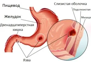 12 exacerbarea tratamentul ulcerului și ulcer duodenal la domiciliu