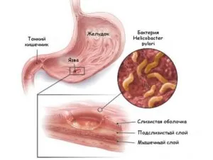 12 exacerbarea tratamentul ulcerului și ulcer duodenal la domiciliu