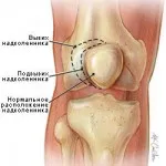 Cum să se dezvolte după ipsos genunchi - care au încă probleme