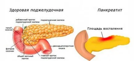 Omez pancreatitis hogyan kell bevenni, utasítások, ellenjavallatok