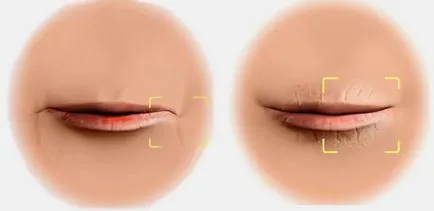 Cum de a elimina ridurile din jurul șir buzele pungă