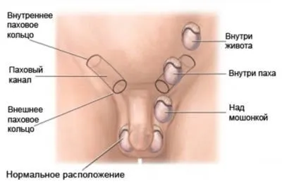 Cum o hernie inghinala pe potența masculină