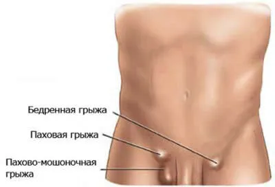 Как действа на ингвинална херния на мъжката потентност