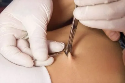 Hogyan nagyobbra nő piercing - meddig benőtt lyuk foghúzás után - Aesthetic Surgery