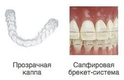 paranteze ceramice autoligaturanți - Alte