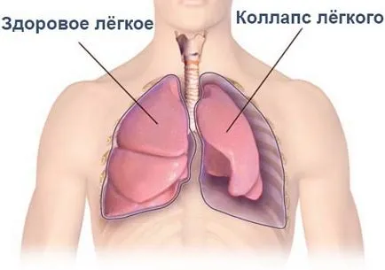 Cauzele valvei pneumotorax, diagnosticul, tratamentul