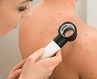 Molluscum contagiosum simptomelor copiilor și tratamente, îndepărtarea cu laser pe fața copilului