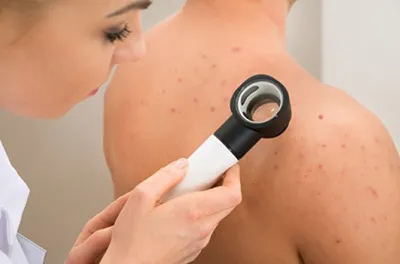 Molluscum contagiosum simptomelor copiilor și tratamente, îndepărtarea cu laser pe fața copilului