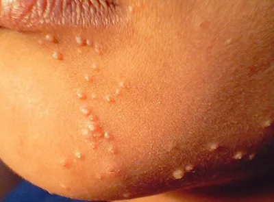 Molluscum contagiosum gyermekeknél a tünetek és a kezelés, lézeres eltávolítása az arcon, a gyermek