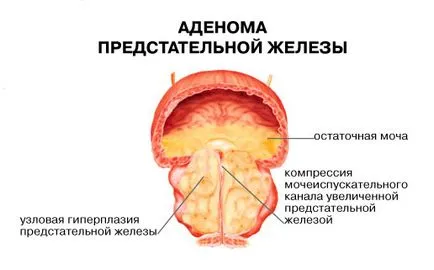 Aspen kéreg prosztata adenoma receptek a hagyományos gyógyítók