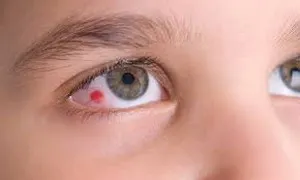 кръвоизлив очите - предизвиква нарушение на целостта на стените на капилярите очни видове кръвоизливи