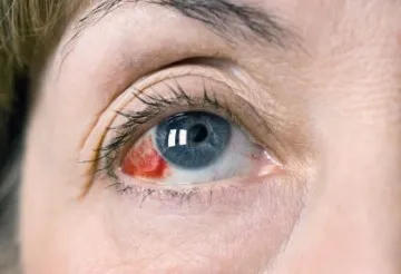 Eye vérzés - okozza épségének megsértése a falak szemészeti hajszálerek féle vérzések