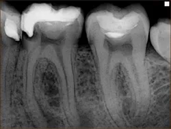 Metode optice pentru diagnosticarea precoce a cariilor cu laser fluorescenta, diagnosticare fascicul,