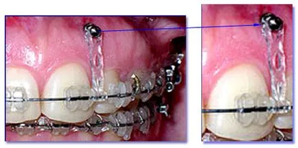 ортодонтски импланти