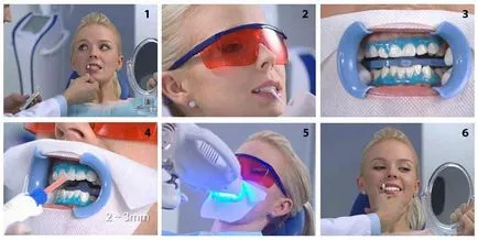 Whitening túl Pólus