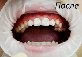 caries kezelés fúrás nélkül a fogászatban