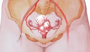 fibrom uterin tratament eficient de remedii populare, care au ajutat