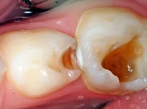 caries kezelés nélkül fúrófogak szakvélemény