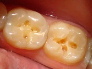 caries kezelés nélkül fúrófogak szakvélemény