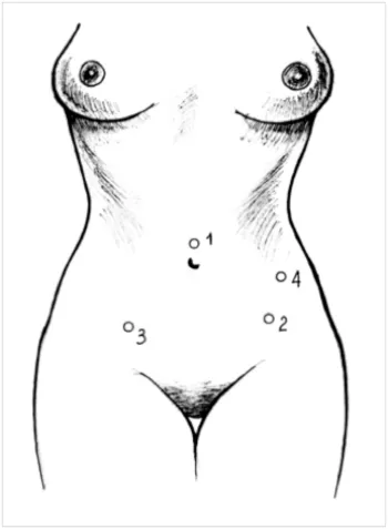 Tratamentul de cancer al uterului, folosind chirurgia laparoscopică
