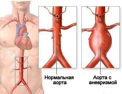 Лечение на корема аортна аневризма, стойност коремна операция аневризма