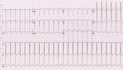 remedii populare tahicardie Tratament ambulatoriu