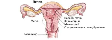 Полипи на матката лечение на народната медицина, здравеопазване и медицина