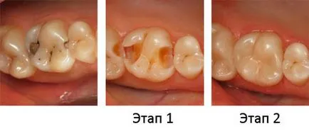 caries kezelés nélkül fúrófogak szakvélemény