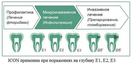 caries kezelés fúrás nélkül a fogászatban