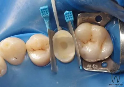 Tratamentul cariilor si restaurare de dinti dupa tratamentul de canal - terapie - știri și articole