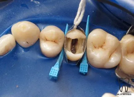 Tratamentul cariilor si restaurare de dinti dupa tratamentul de canal - terapie - știri și articole