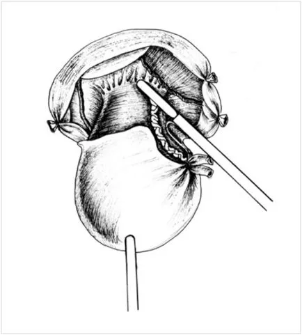 Tratamentul de cancer al uterului, folosind chirurgia laparoscopică