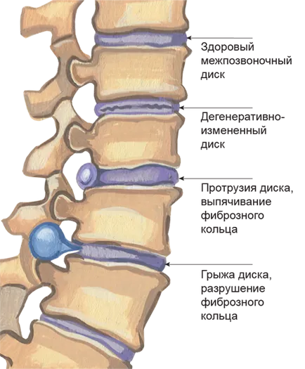 Tratamentul osteocondrozei în Kostanay