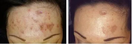 Melasma și stări patologice la hiperpigmentare