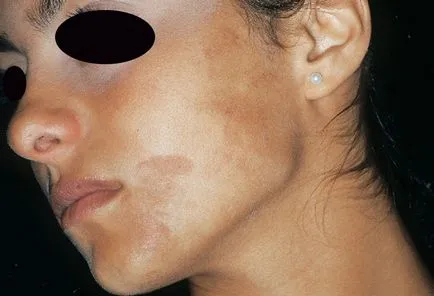 Melasma și stări patologice la hiperpigmentare