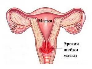 Methyluracyl свещи гинекологични употреба, показания и противопоказания