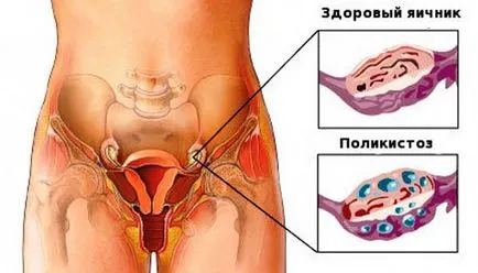 Мензес неправилни причини и лечение на нестабилна цикъл