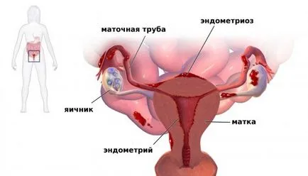 Мензес неправилни причини и лечение на нестабилна цикъл