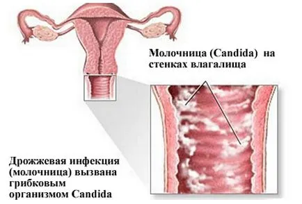 Гъбичките причинява симптомите, диагностиката и инструменти за обработка и свещи от гъбични инфекции при жените