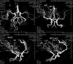 angiografie cerebrală RMN, vasele de sange, artere