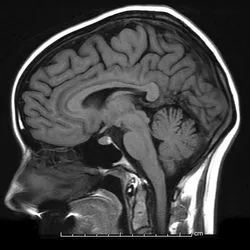 MRI agyi angiográfia, erek, artériák