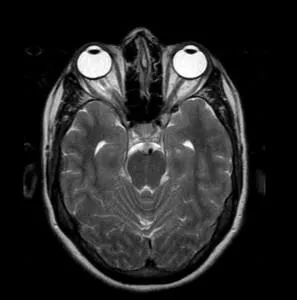 Mri око, което показва, ядрено-магнитен резонанс орбита око и на зрителния нерв на очите