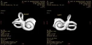 MRI a fül, ha meg kell csinálni egy MRI, CT-vizsgálat, és amikor a belső fül, az ár az eljárás