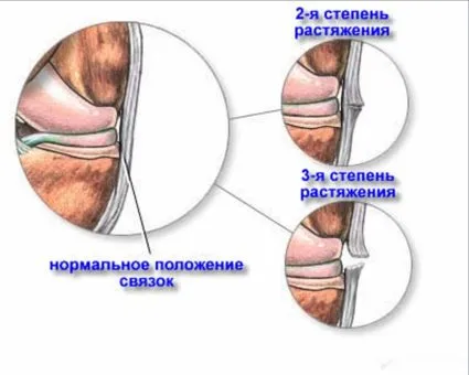 Разкъсване на връзките на коляното - обратен ефект нараняване