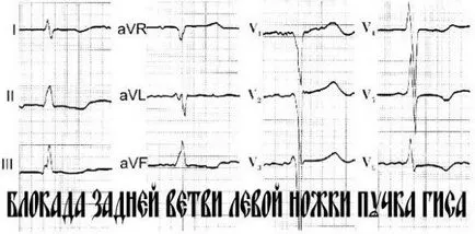 Az EKG szárblokk - tünetek és hatások kezelésére otthon