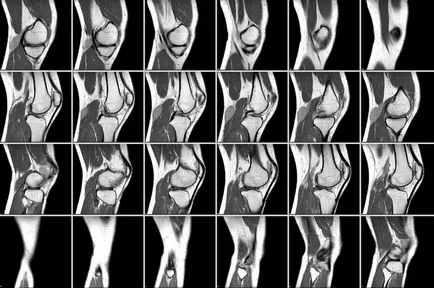 RMN și CT articulației genunchiului - acel spectacol și care este diferența
