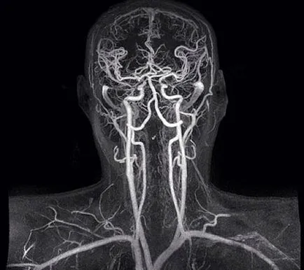 MRI на мозъчните артерии - което трябва да знаете