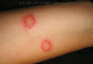 Pityriasis versicolor gyermekek tünetei, kezelése, fotók